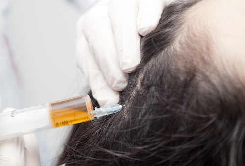   Hair Loss Treatment with Adipose Derived Cells