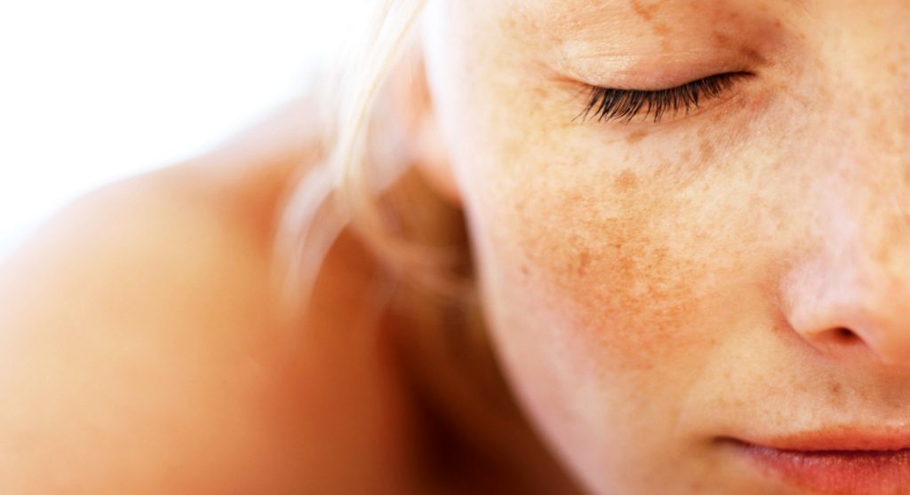 Understanding and Managing Melasma as an Aesthetic Skin Disorder