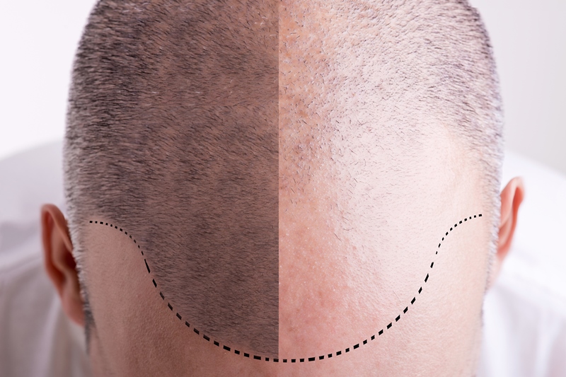Hair Transplant a Growing Option in the UAE